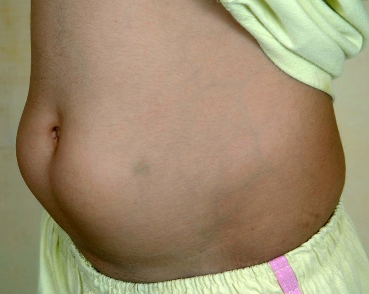 <p><span>where fat tissue builds up under the skin at insulin injection sites, causing lumps or bumps.</span></p><p><span><strong>Prevention:</strong> rotate injection sites</span></p>