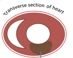 <p>A STEMI indicates ____ _________  (inside and out) damage of the heart muscle (tissue death).</p>