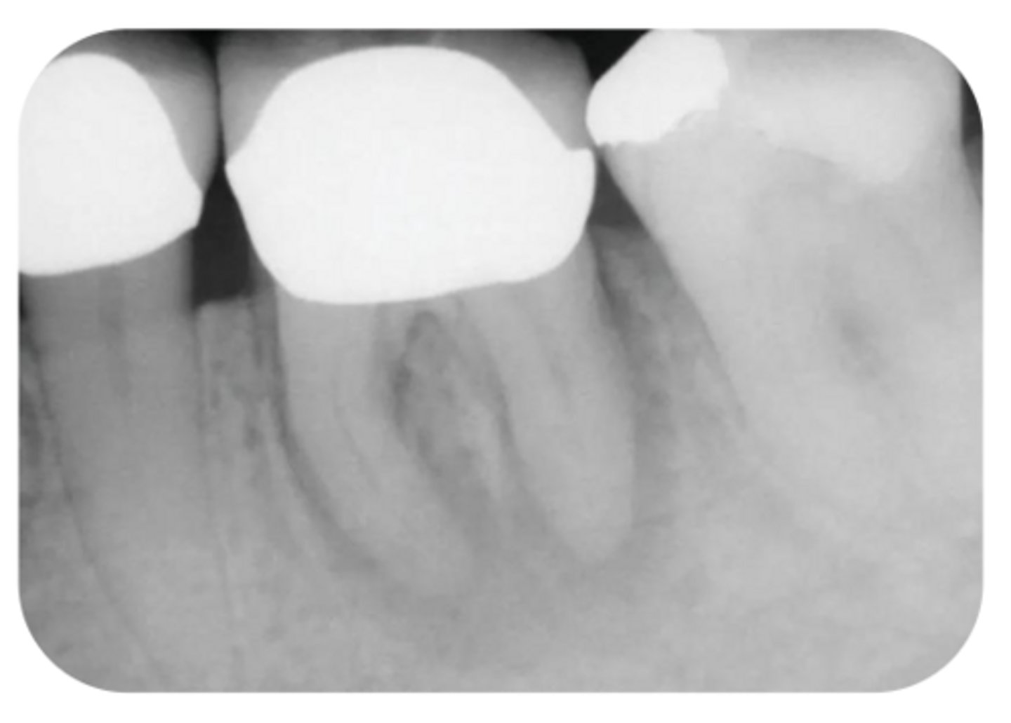 <p>What are the radiographic findings on #19?</p>