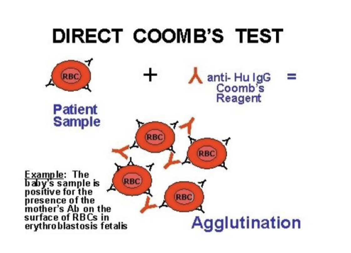 <ul><li><p>tests for presence of antibodies on fetal RBC’s</p></li><li><p>antibodies can be related to RH factor OR blood type</p></li><li><p>blood</p><img src="https://knowt-user-attachments.s3.amazonaws.com/65706d3f-3f7d-43a4-b920-abcdc8620f8a.png" data-width="50%" data-align="center" alt="knowt flashcard image"></li><li><p>Postiive = antibodies present</p><ul><li><p>which places the newborn at high risk for hyperbilirubinemia</p></li></ul></li></ul><p></p>