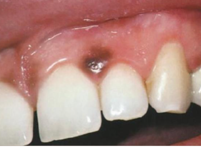 <p>what is this lesion? </p>