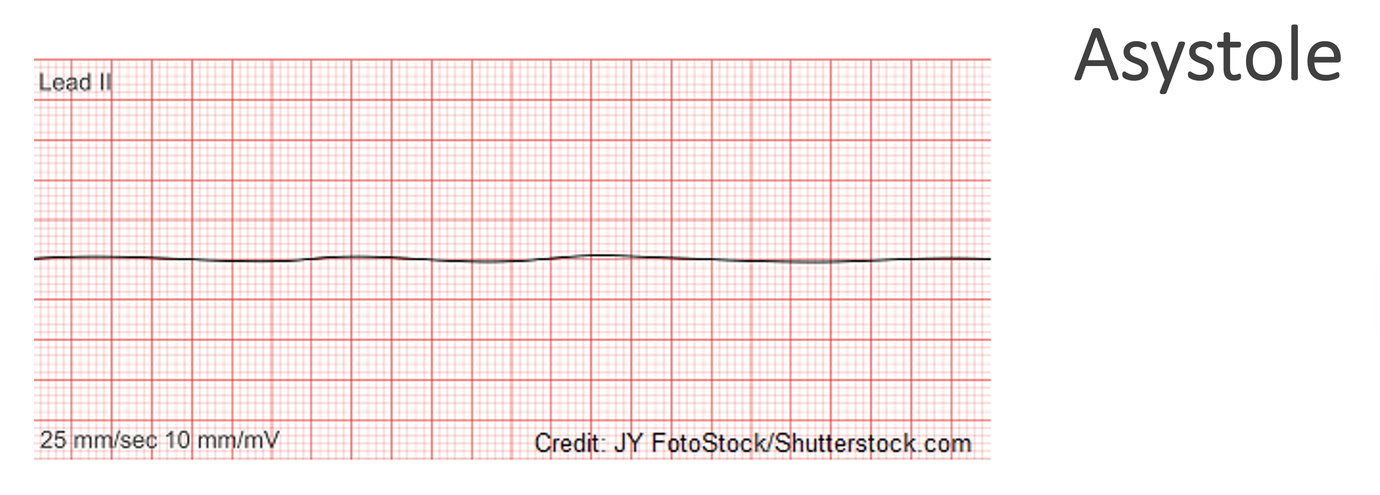<p>Asystole</p>