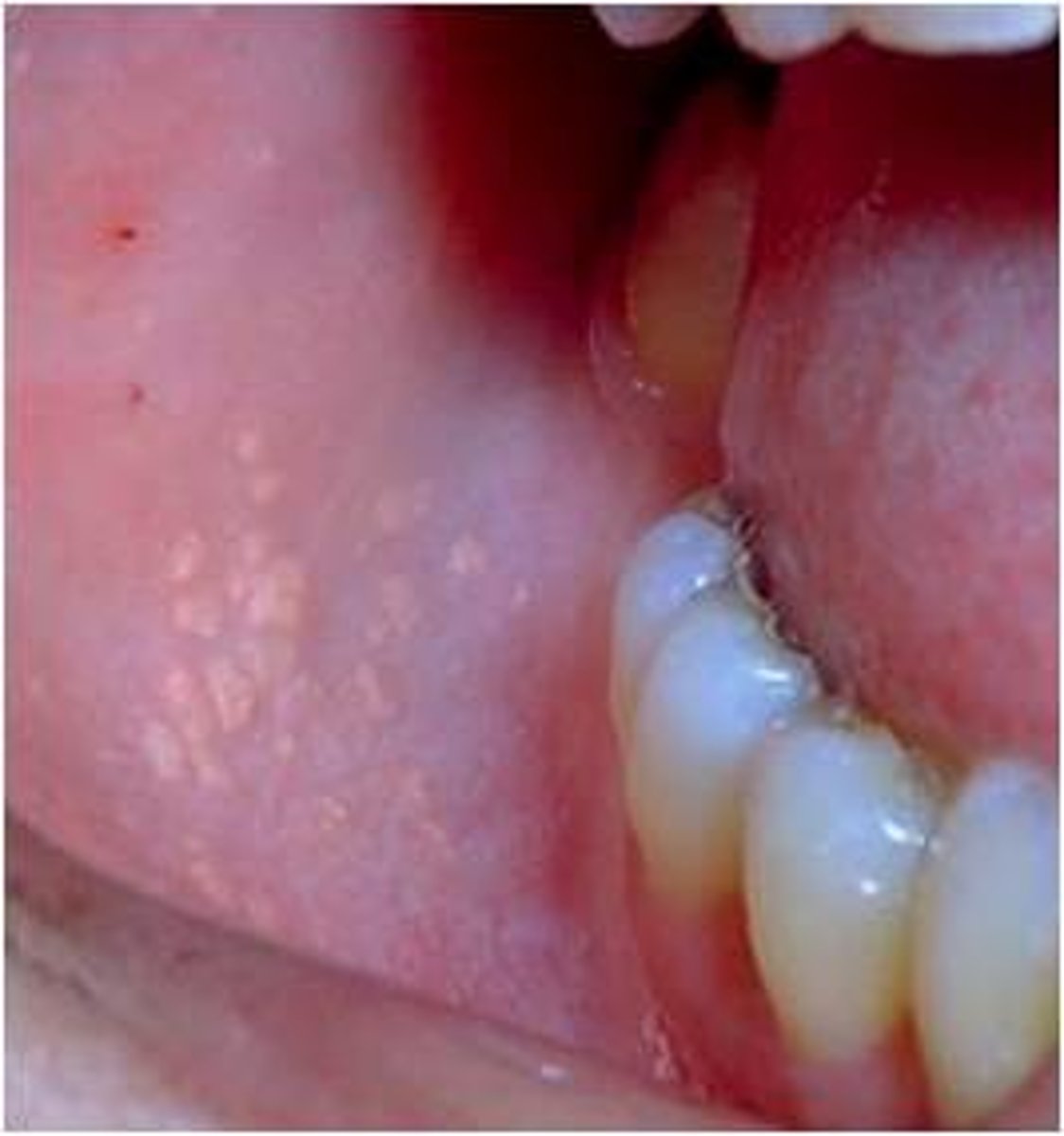 <p>Misplaced sebaceous glands in the mucosa of lips, cheeks, and retromolar pad area</p><p>*appear as yellowishh granular structures embedded in the mucosa. they are benign.</p>