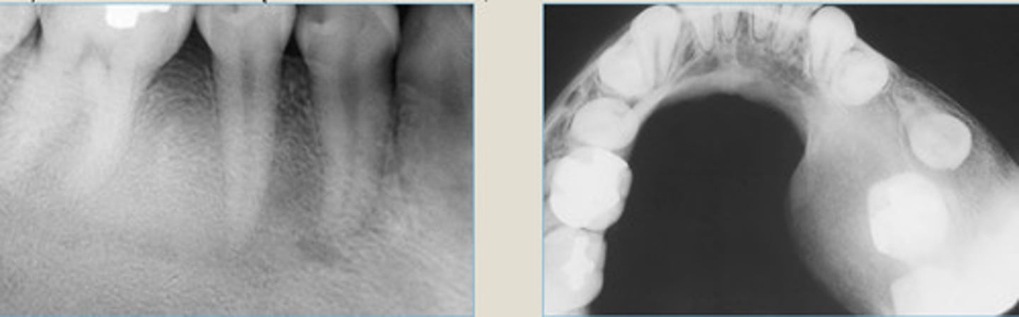 <p>Diffuse "ground glass" radiographic appearance</p><p>Takes over lamina dura + alveolar crests</p><p>Margins ill-defined + blend into bone</p>
