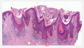 <p><strong>Inflammation at the dermal-epidermal junction</strong><span> → “</span><strong>saw-tooth</strong><span>” appearance.</span></p>