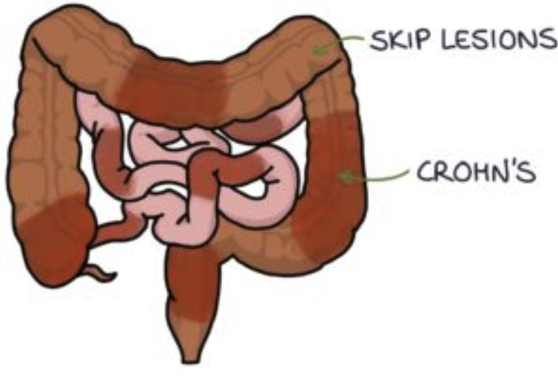 <p><span>areas of inflammation or tissue damage in the gastrointestinal tract that are separated by healthy tissue</span></p>