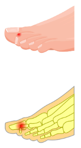 DIP in flexion 