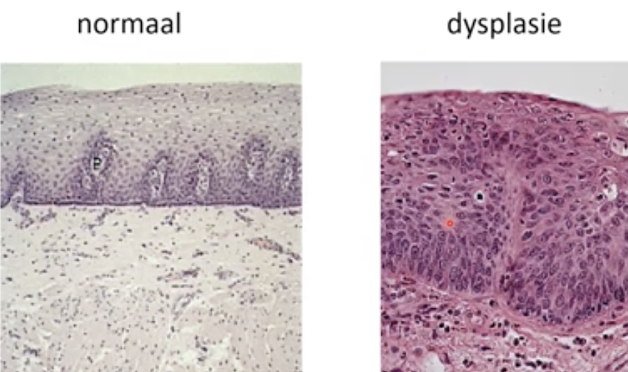 Dysplasia of squamous epithelium 