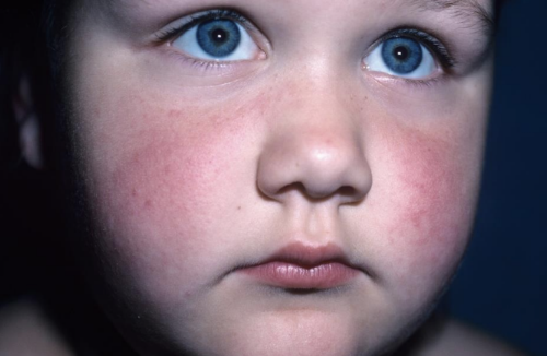 <p>Produces a Mild Rash</p><ul><li><p>caused by Parvoviridae, Parvovirus B19</p></li></ul><ul><li><p>transmitted by respiratory droplets</p></li><li><p>Symptoms include a fiery red (“slapped check”) rash on the cheeks and ears, and trunk. It disappears within a few days</p></li></ul><ul><li><p>Adults can experience symptoms similar to those of rheumatoid arthritis</p></li><li><p>treatment includes supportive care</p></li></ul><p></p>
