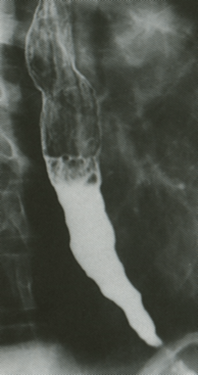 <p>Achalasia</p>