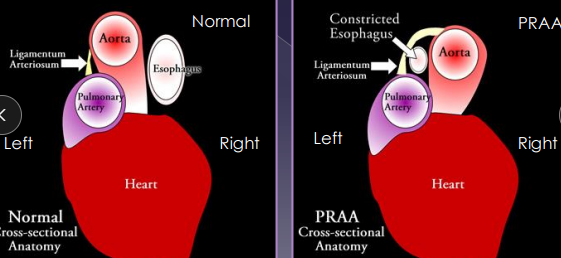 <p><span>Vascular Ring Anomalies</span></p>