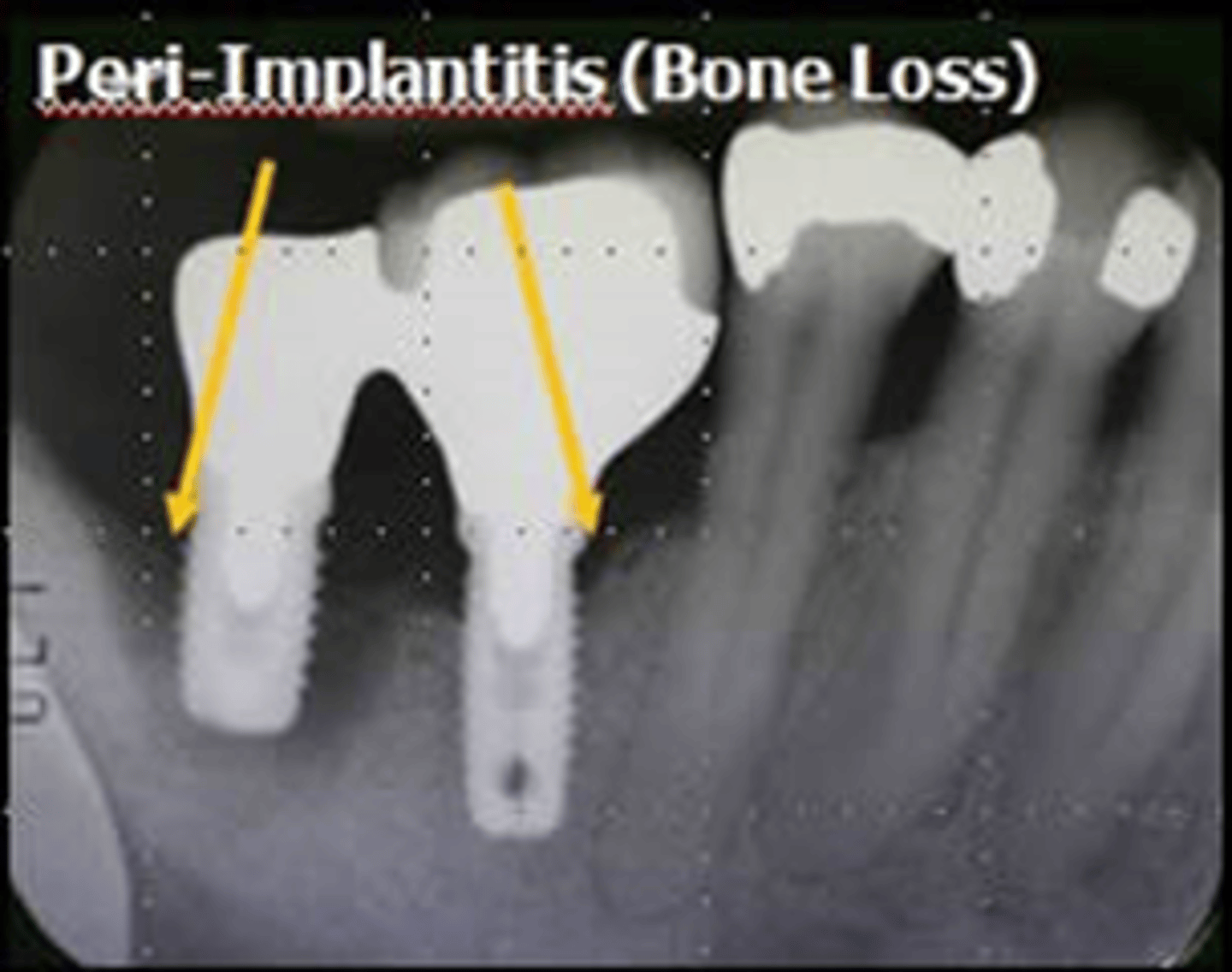 <p>- Inflammation in the peri-implant soft tissues</p><p>- Chronic periodontitis in tissues surrounding osseointegrated implant</p><p>- BL</p><p>'saucering'</p>