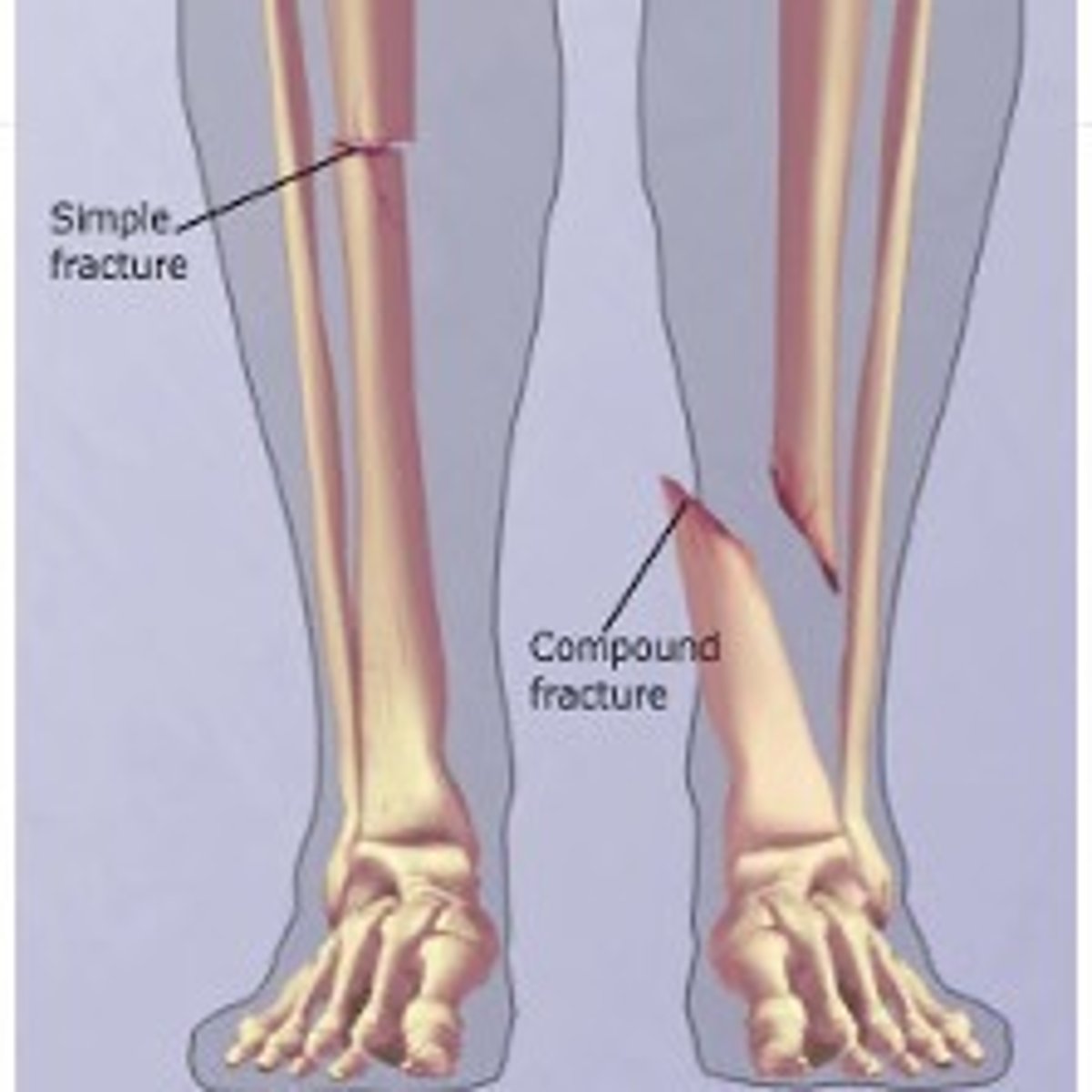 <p>a fracture in which a portion of the bone protrudes through the skin (classification)</p>