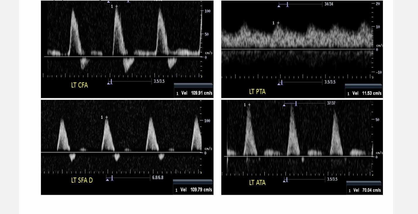 <p>which is a left popliteal artery waveform</p><p>.</p><p>a) A</p><p>b) B</p><p>c) C</p><p>d) D</p>