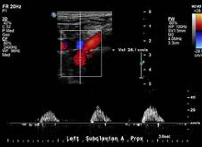 <p>Consider this LT sided subclavian artery waveform. Where is obstruction?</p><p>With this finding, what might you find in the ipsilateral vertebral artery? </p>