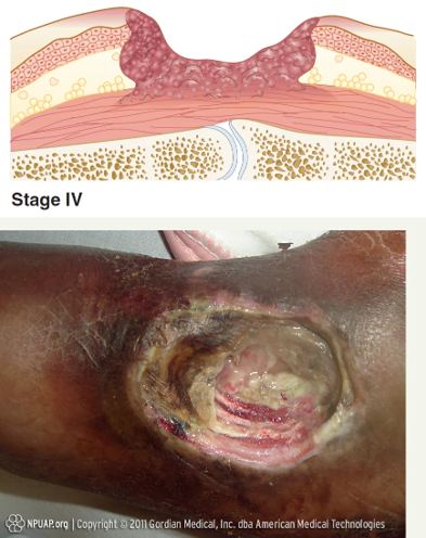 <p>Full- thickness skin loss</p><p>Muscle is exposed with damage </p><p>Slough and eschar are present</p><p>Bone or tendon may also be exposed </p>