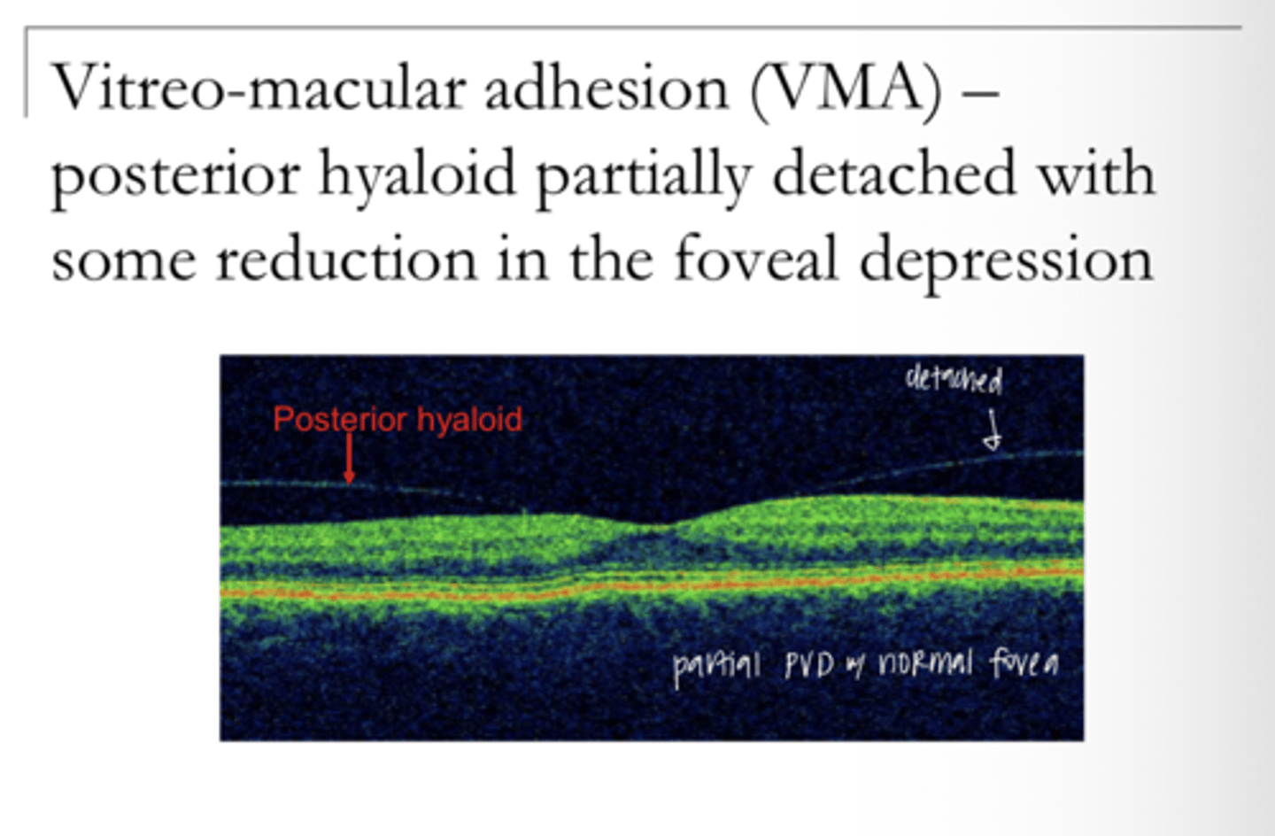 <p>Describe Vitreomacular Adhesion (VMA)</p>