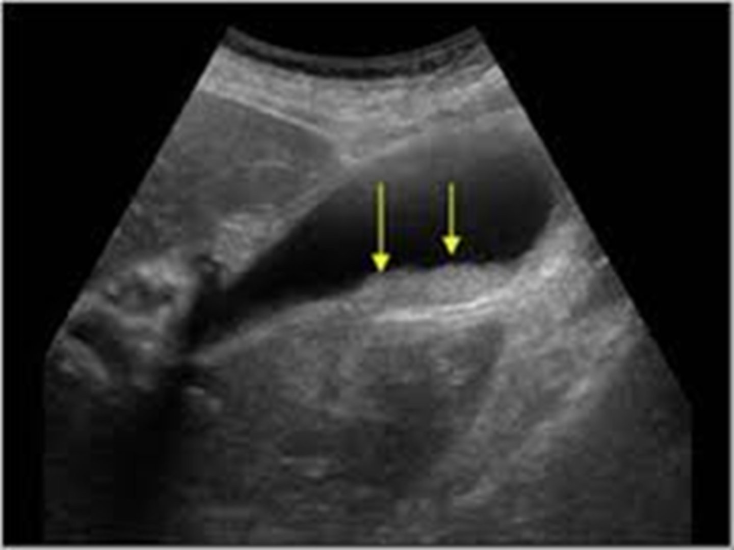 <p>aggregation that may contain cholesterol crystals, bilirubin, glycoprotein, often associated with biliary stasis</p><p>echogenic in gallbladder lumen, no acoustical shadowing</p>