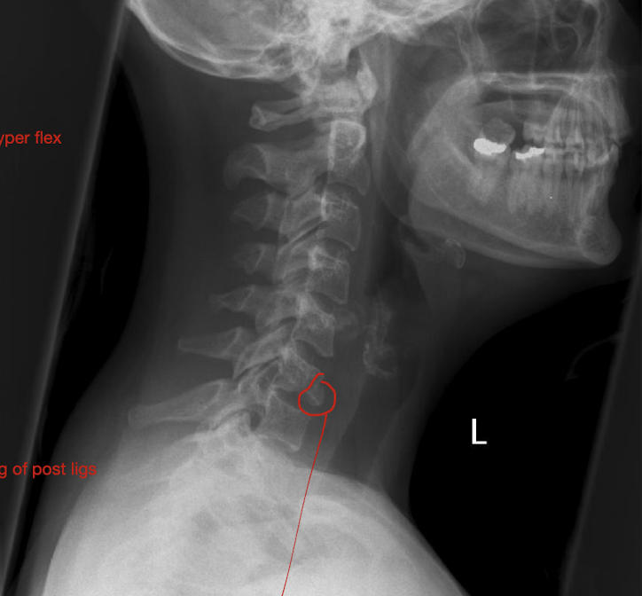 <p>Fracture of C3-C7: Tear Drop Fx</p><ul><li><p>What is this fx known as?</p></li><li><p>How does it occur?</p><ul><li><p>2</p></li></ul></li></ul><p></p><p></p>