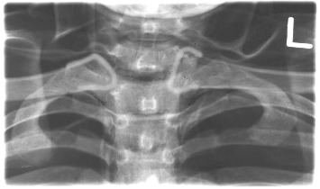 <p>Is this patient flexed or extended?</p>