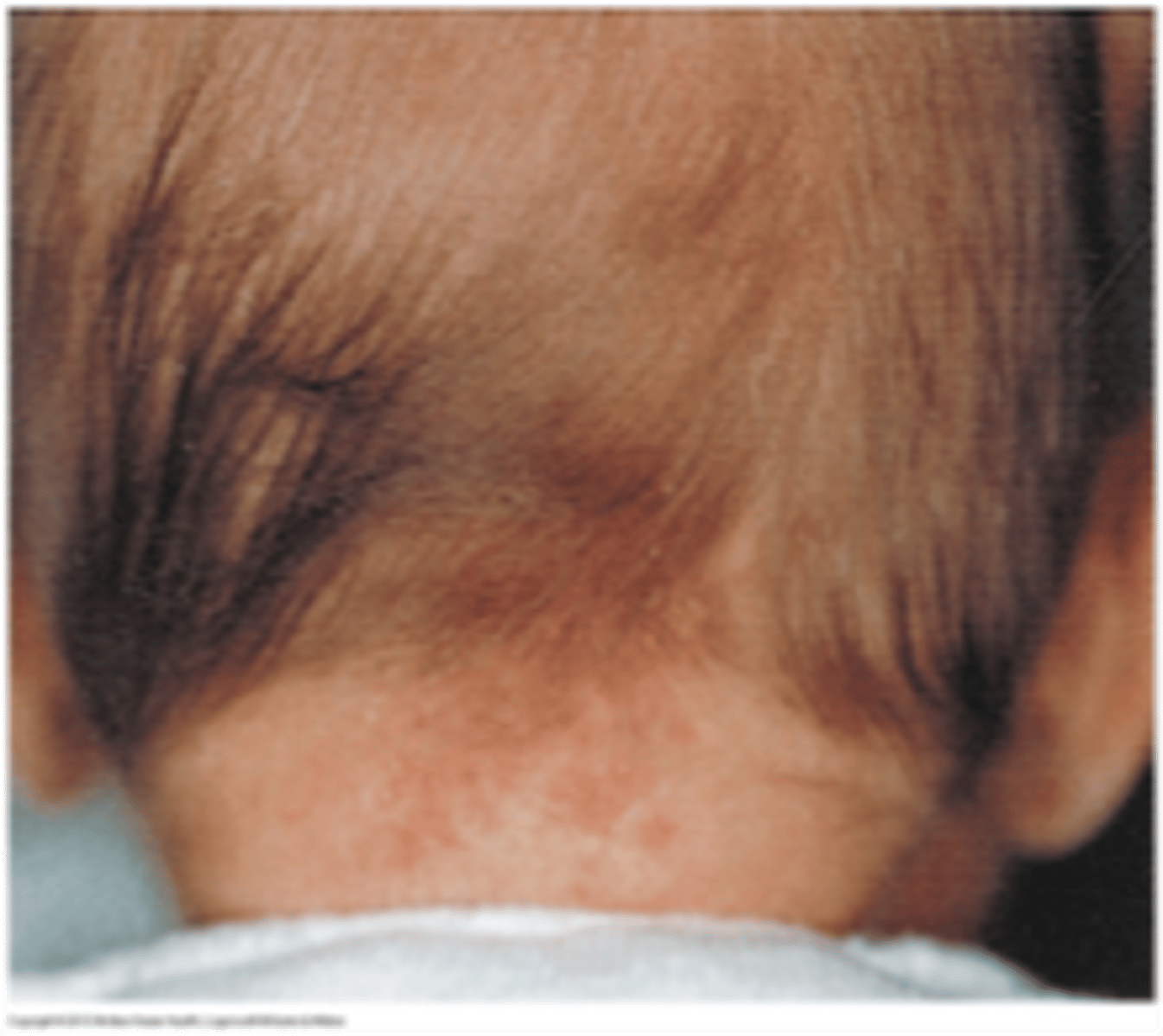 <p>stork bite or angel kiss</p><p>common vascular marking most common ar the nape of the neck</p><p>fades with age</p>