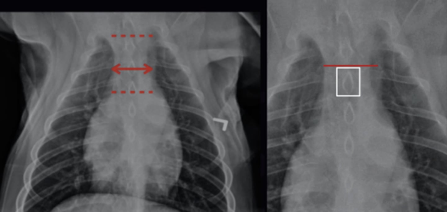 <p>1. First ribs to the cranial aspect of the Heart. Measure in the middle of these locations</p><p>2. Trachea, Oesophagus, Vessels, Lymph nodes. All structures are soft tissue opacity (except trachea) so they efface.</p><p>3. Measure on VD View. Locate first ribs and cranial heart border. Measure the Width halfway between these structures. Normal width is &lt;2x the width of the vertebra (Wider in brachiocephalic/obese dogs</p>