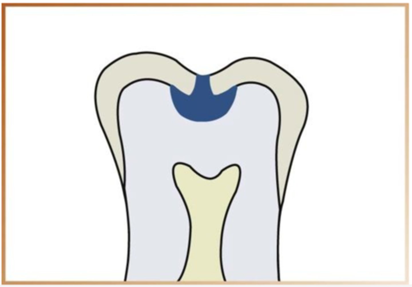 <p>extends into dentin and appears radiolucency</p>