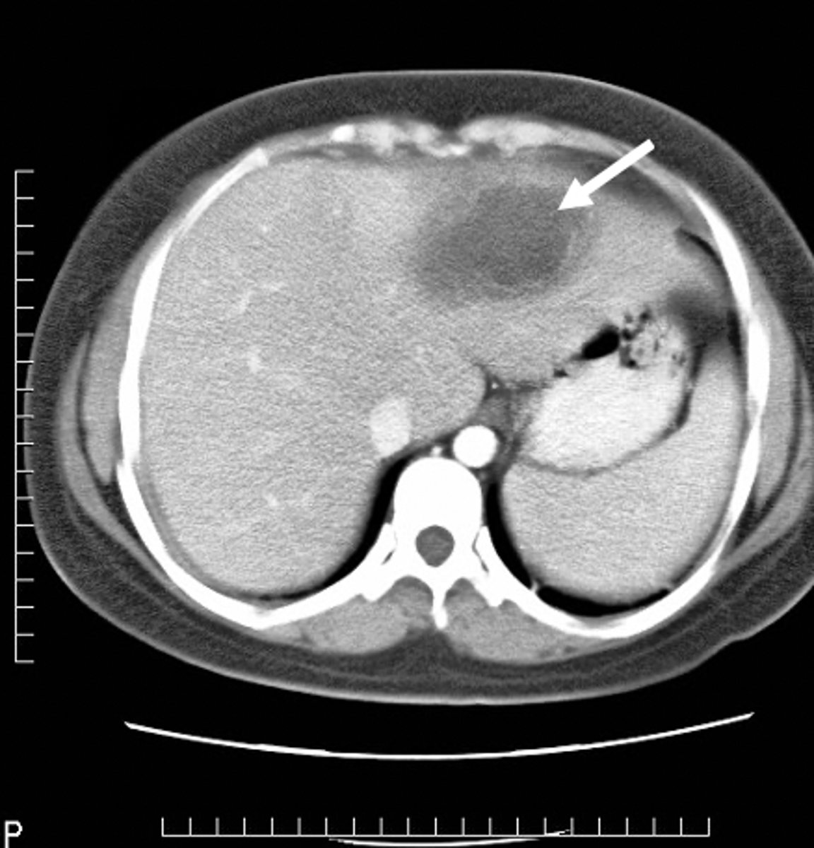 <p>localized collection of pus, low density lesion</p>