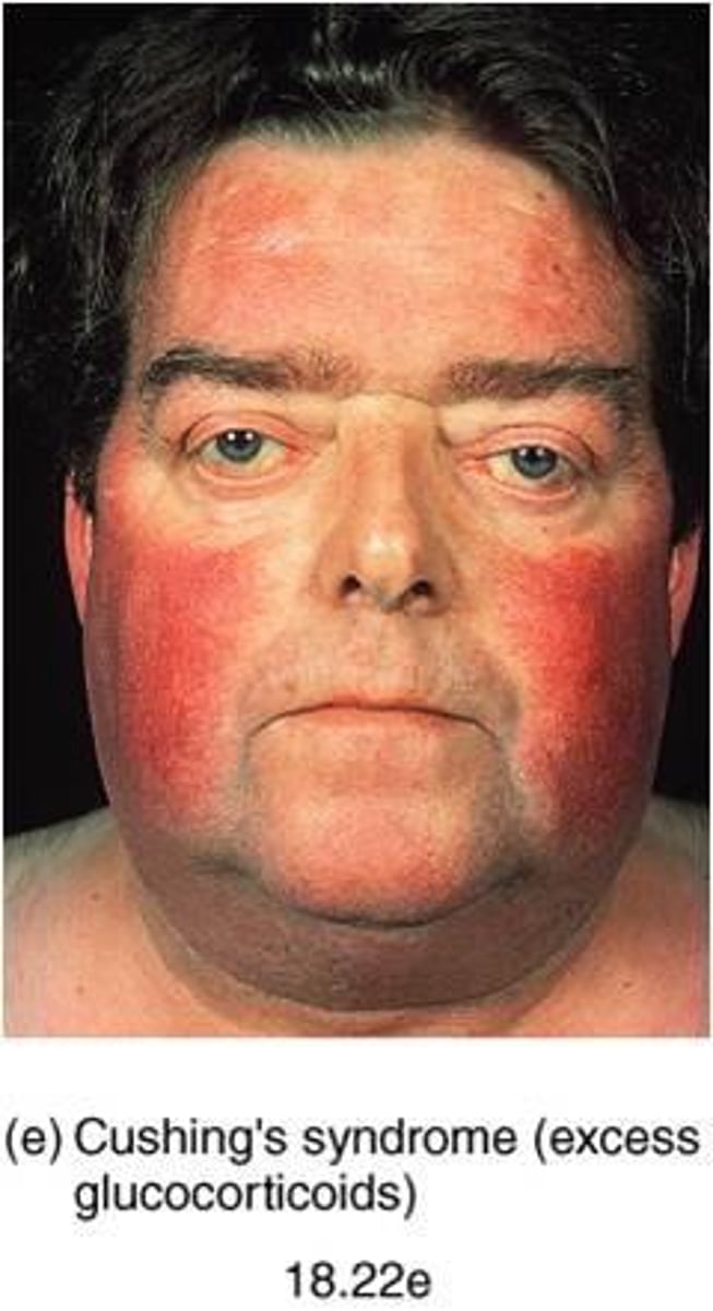 <p>red/moon face</p><p>red cheeks</p><p>excessive hair growth</p>