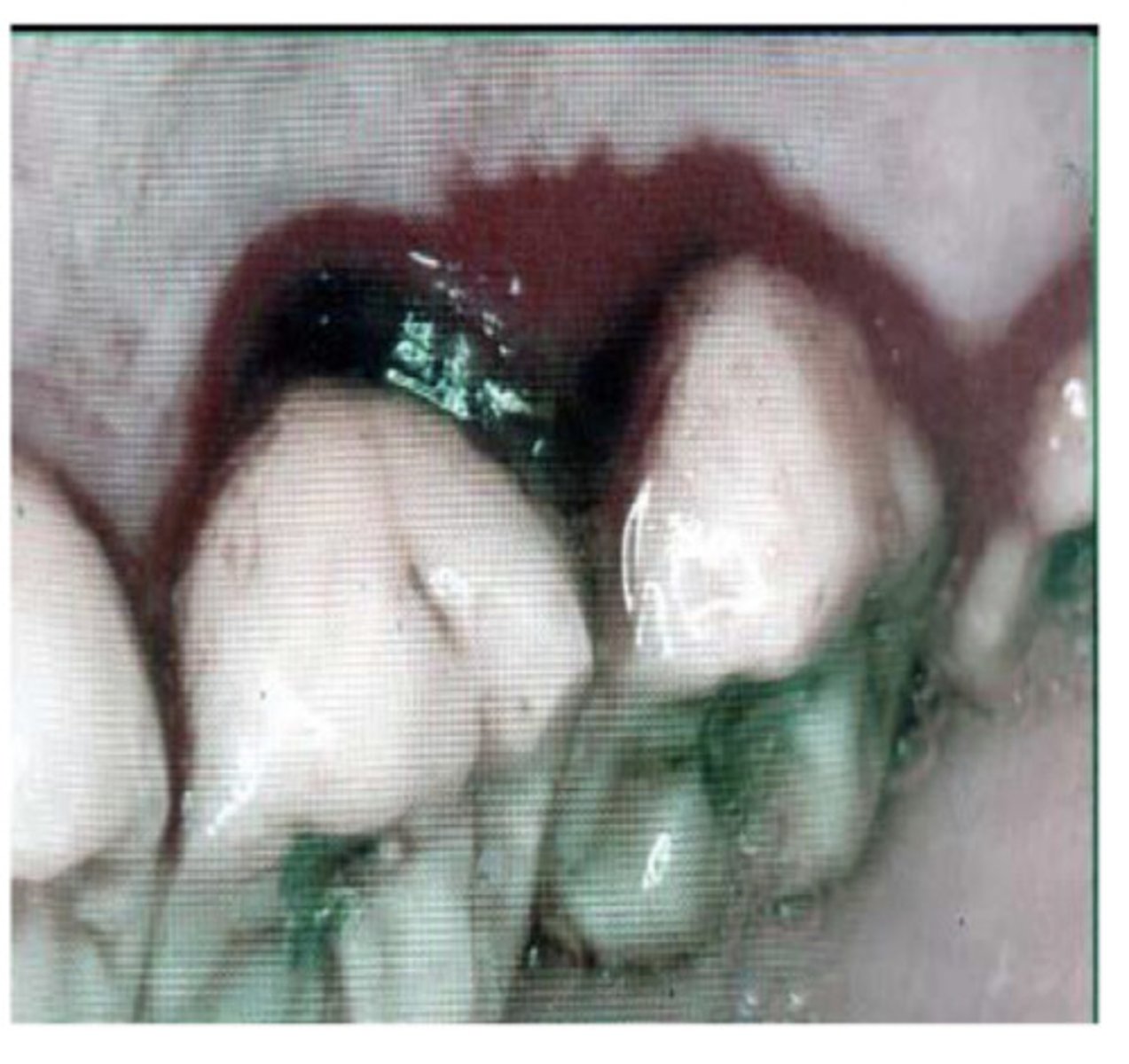 <p>What is this? - haemorrhagic areas/ patches normally along gingivae with no associated plaque</p>