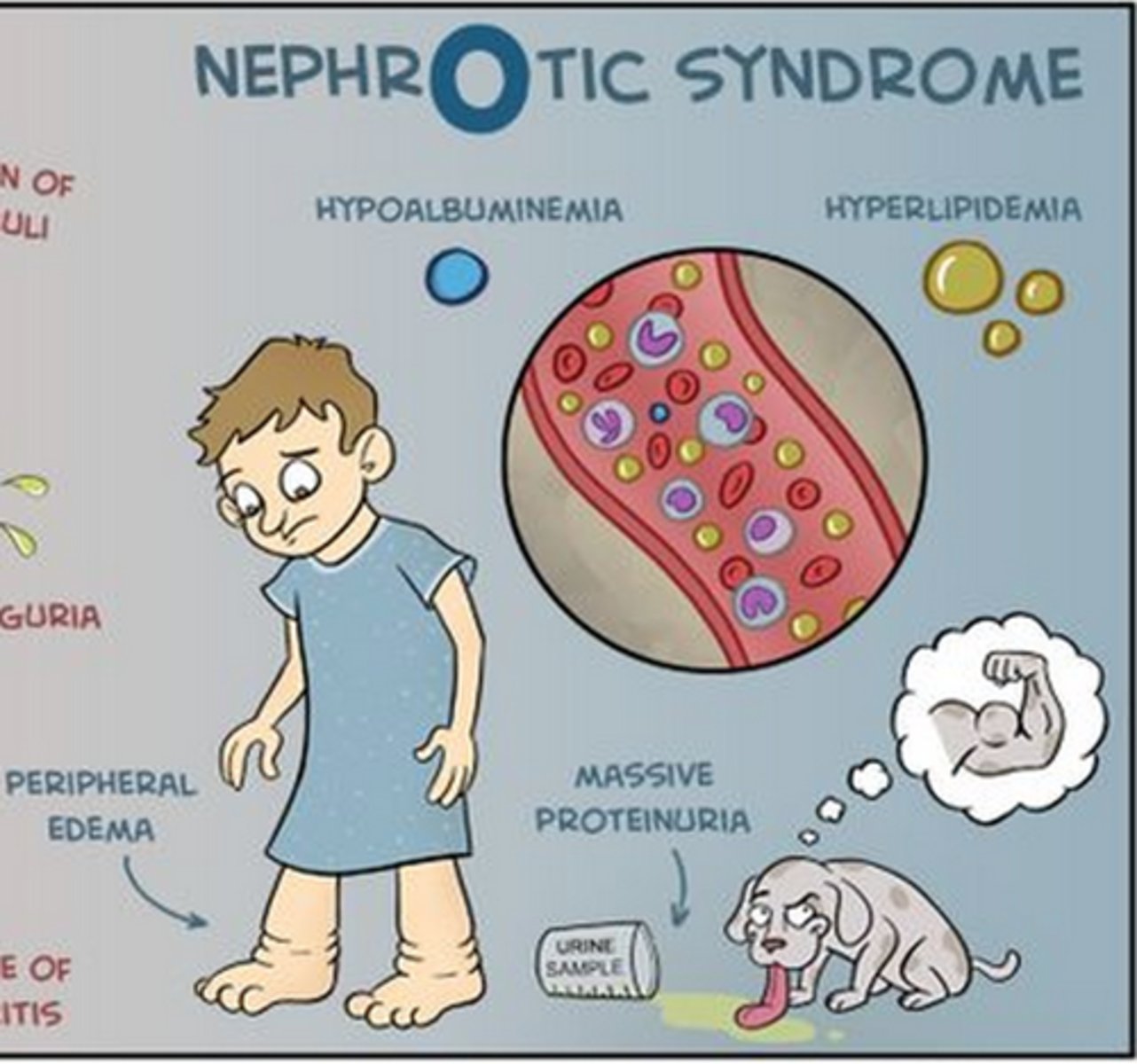 <p>b. Recent weight gain</p><p>Nephrotic syndrome results when the glomerulus is excessively permeable to plasma protein, causing proteinuria that leads to low plasma albumin and edema.</p><p>Lewis MS Clinical Companion pg 413</p><p>The common manifestations are peripheral edema, massive proteinuria, hyperlipidemia, hypoalbuminemia, and foamy urine. The increased glomerular membrane permeability is responsible for the massive excretion of protein in the urine. This results in decreased total serum protein and subsequent edema formation. Ascites and anasarca (massive, generalized edema) develop if there is severe hypoalbuminemia.</p><p>pg 1206</p>