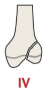 <p>Combo of 2 and 3, runs from metaphysis through the physis and out the epiphysis</p>