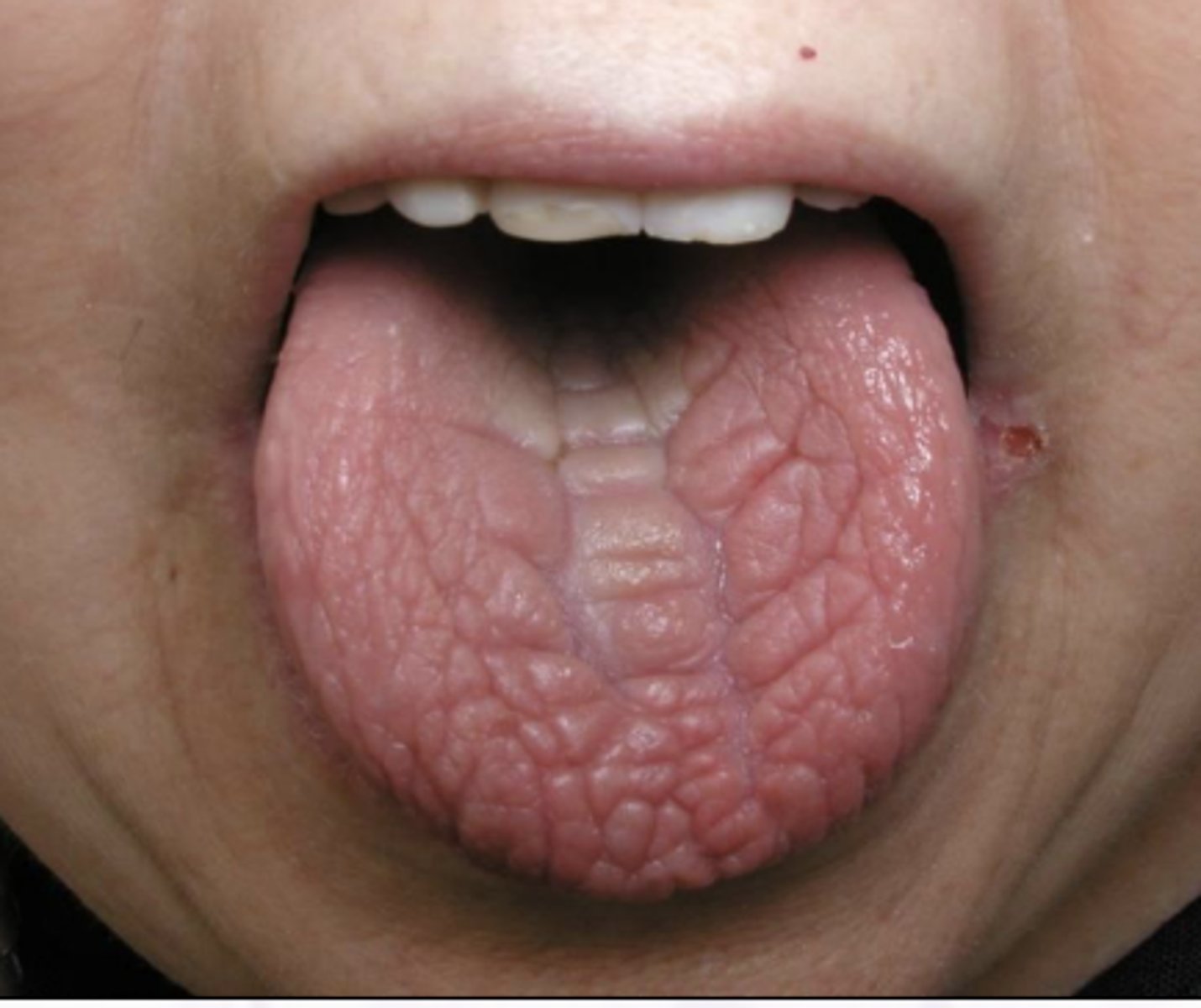 <p>Xerostomia, pain, burning</p><p>Erythematous tissues</p><p>Increased caries</p><p>Increased perio</p><p>Increased candidiasis</p>