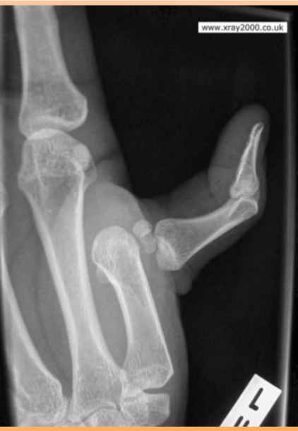 <p>dislocation of thumb </p>