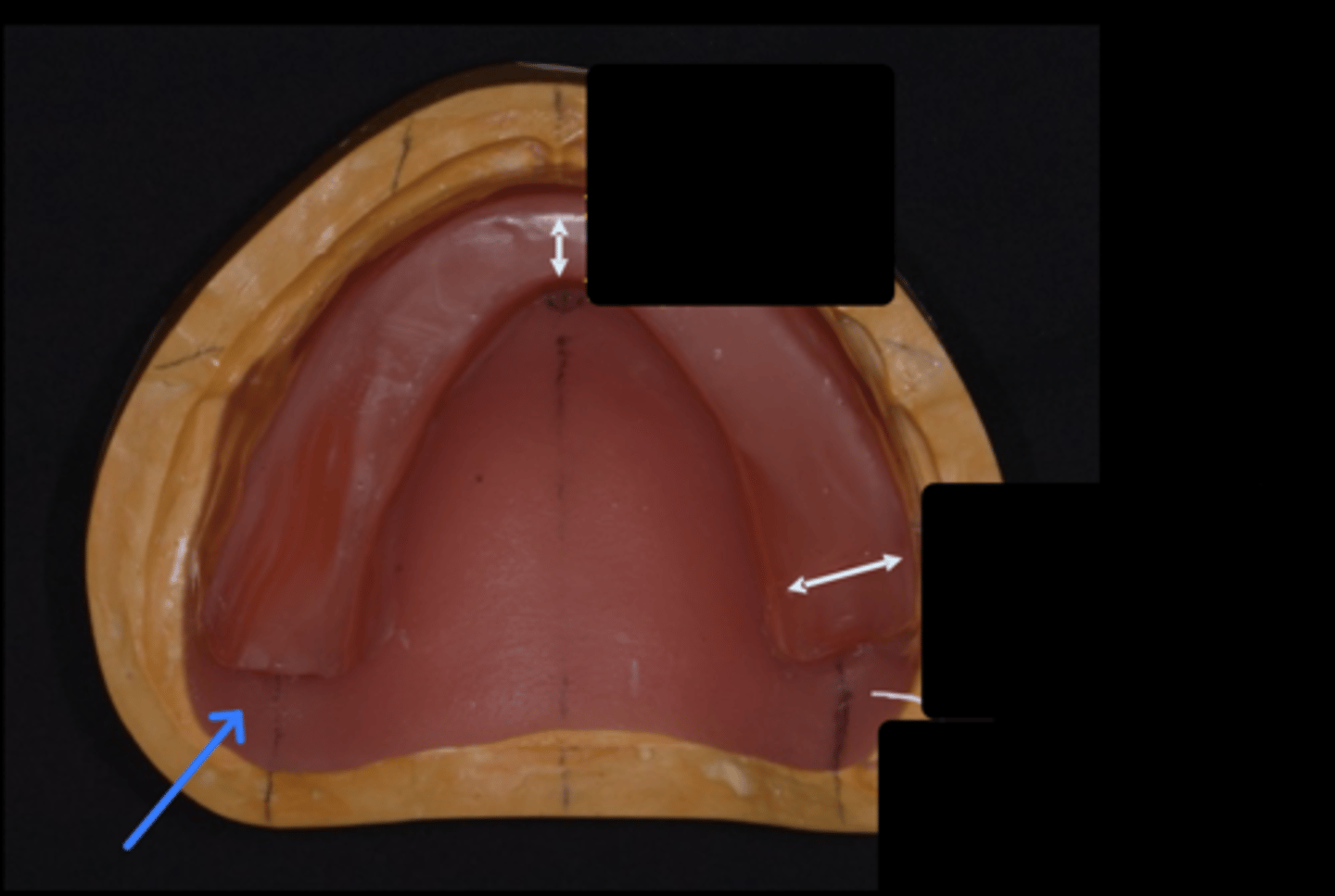 <p>What should the wax NOT cover at the blue arrow?</p>
