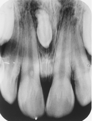 <p>Which term BEST describes the dental anomaly is seen in this image?</p><p> </p><p>supernumerary tooth</p><p> </p><p>dilaceration</p><p> </p><p>mesiodens</p><p> </p><p>teeny tiny tooth</p>