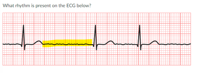 <p>JONES IN CLASS ASSIGNMENT QUESTIONS:</p><p>a. complete heart block</p><p>b. non-STEMI</p><p>c. Atrial fibrillation</p><p>d. atrial flutter with 4:1 transmission</p>