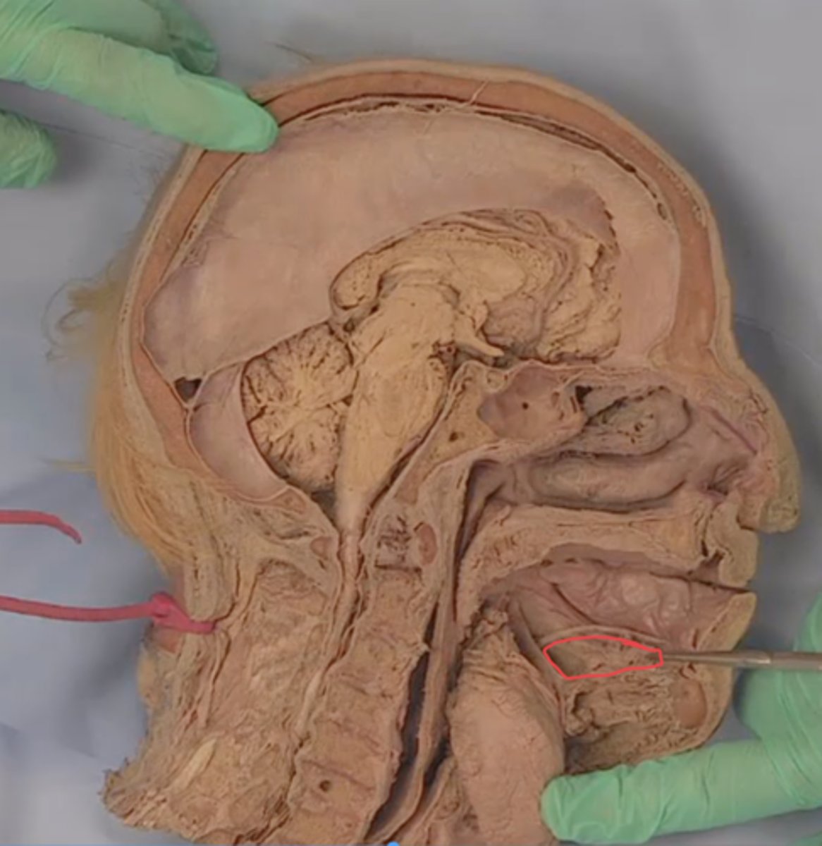 <p>identify structure that lies in this fossa (tongue reflected)</p>