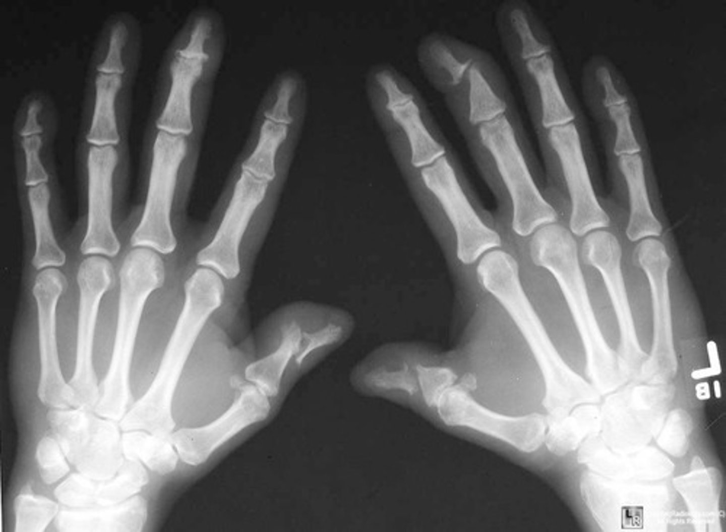 <p>inflammatory arthritis associated with psoriasis, skin and nail changes along with joint changes, hands and feet usually</p><p>- juxtaarticular erosions</p><p>- enthesophytes -&gt; bony proliferation at sites of tendon insertions</p><p>- pencil in cup deformity</p><p>- absence of osteoporosis</p>