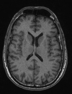 <p>a plane of dissection that divides through the brain’s rostral and caudal sides</p>