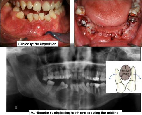 <p>What is the growth pattern for odontogenic keratocyst?</p>