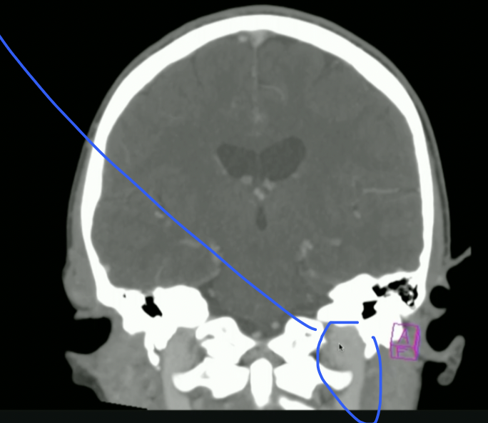 <p>What vein is highlighted?</p>