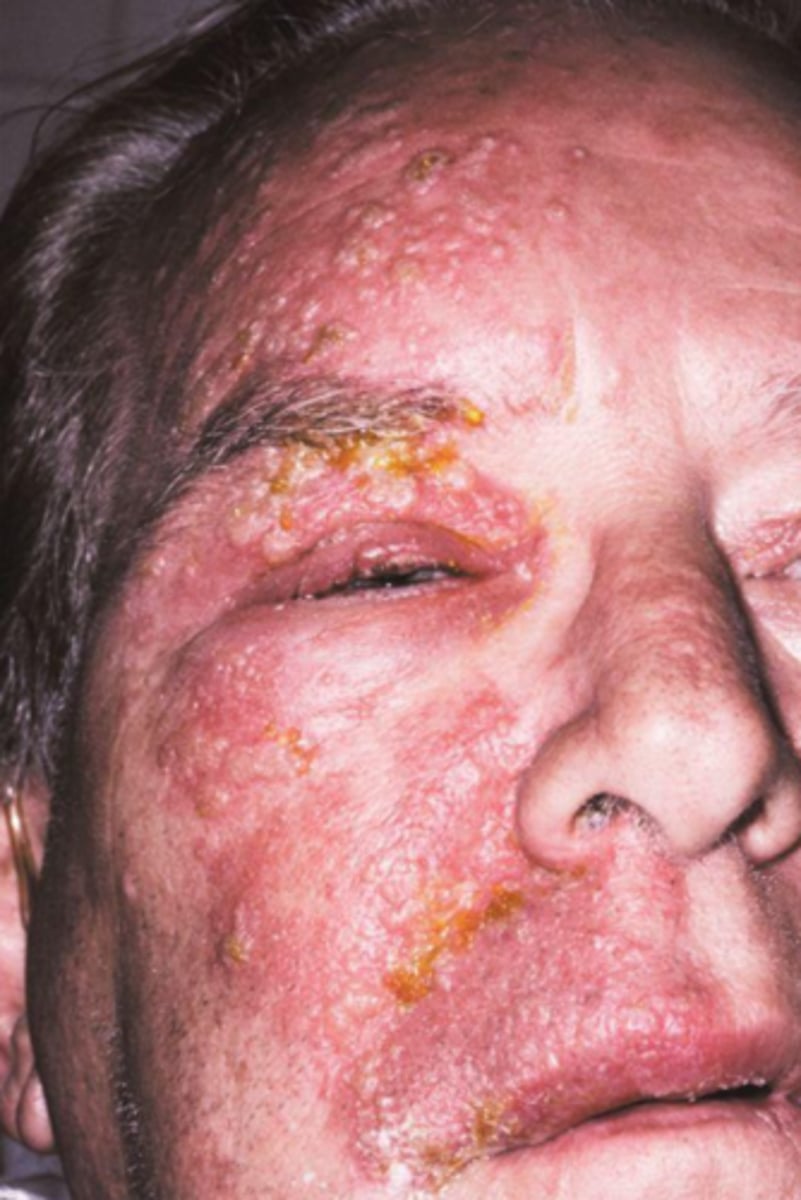 <p>false; shingles follows a unilateral distribution of the peripheral nerve that is infected, most commonly on the trunk and trigeminal area</p>