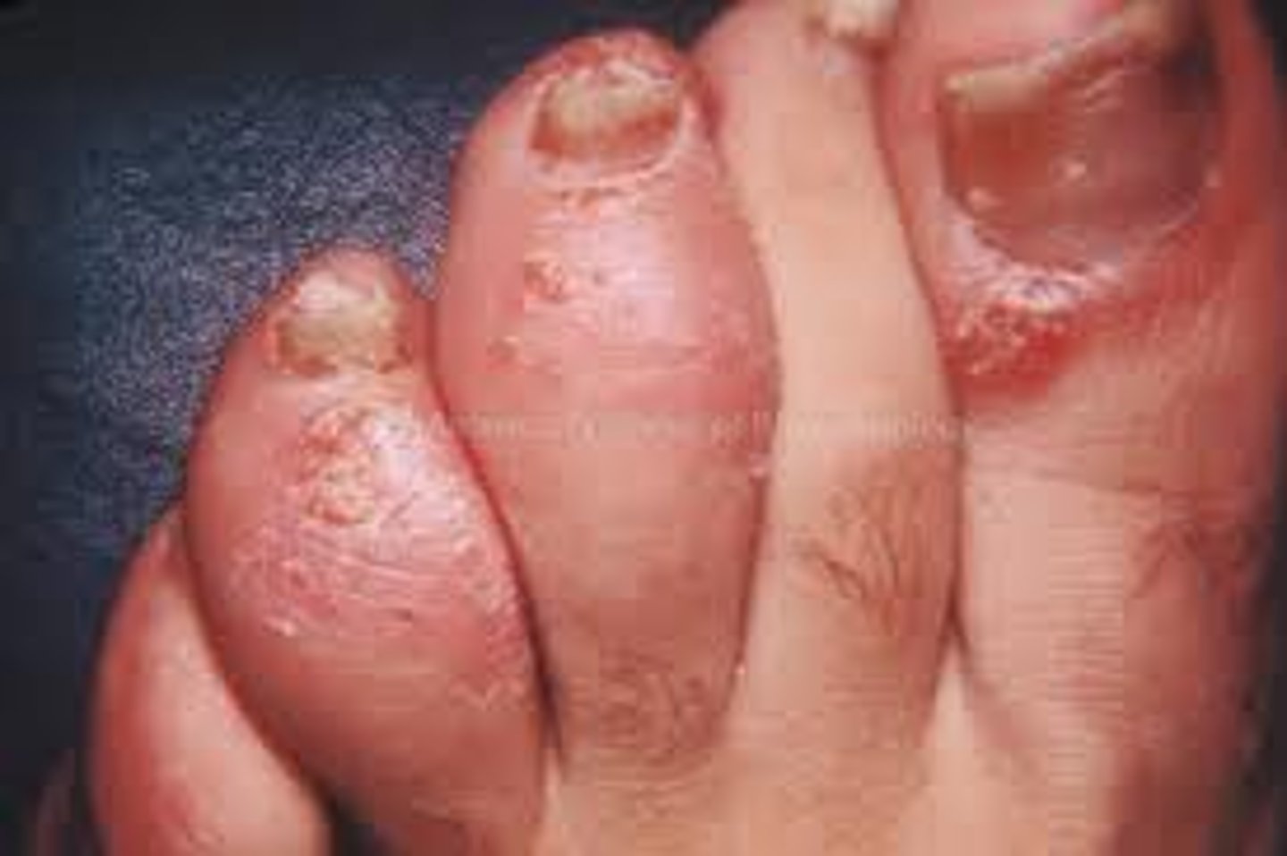 <p>diagnose this condition:</p><p>this may have skin involvement but not all and if nail involvement it is often severe</p>