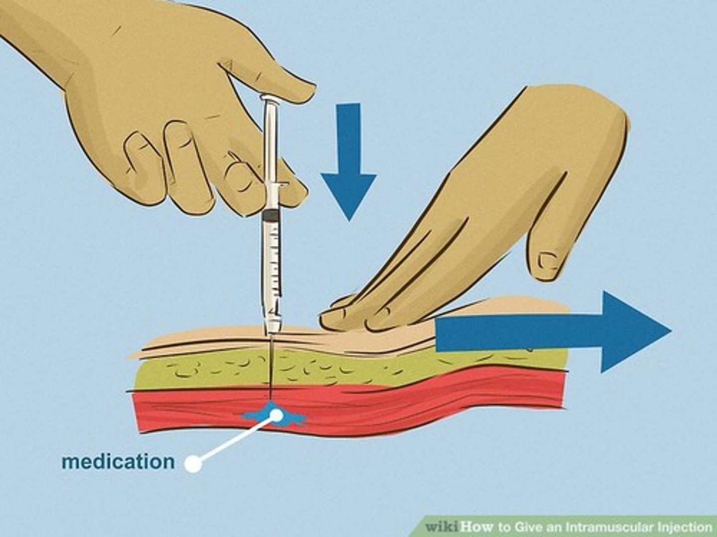 <p>(B) Intramuscular</p><p>Intramuscular drug delivery refers to the drug being delivered by needle into the muscle, and can be either a quick or slow delivery of the drug</p>