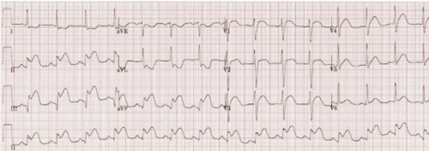 <p>A 67 year old male with PMH of HTN and dyslipidemia presents to the ED with complaints of dyspnea and chest pain that began 4 hours ago. Upon interview, he states that the pain is radiating down his left arm. Cardiac biomarkers come back with positive troponins. EKG is shown below. Which coronary artery is most likely involved?</p><p>LAD</p><p>Circumflex</p><p>RCA</p><p>Distal LAD</p>