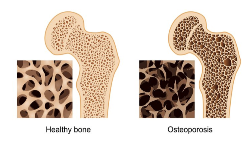 <ul><li><p>Group of diseases in which <strong>bone resorption outpaces bone deposit</strong></p></li><li><p><strong>1 in 3 women over 50</strong> will have a fracture due to osteoporosis</p></li><li><p><strong>Risk Factors:</strong></p></li></ul><p></p>