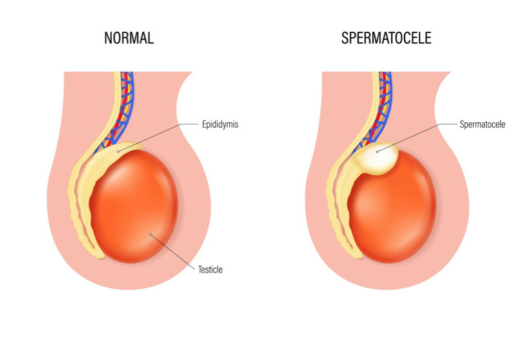 <p>Spermatocele</p>