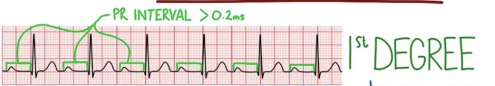 - Delayed conduction thru AV 
- Still sinus rhythm 

ECG: prolonged PR interval 