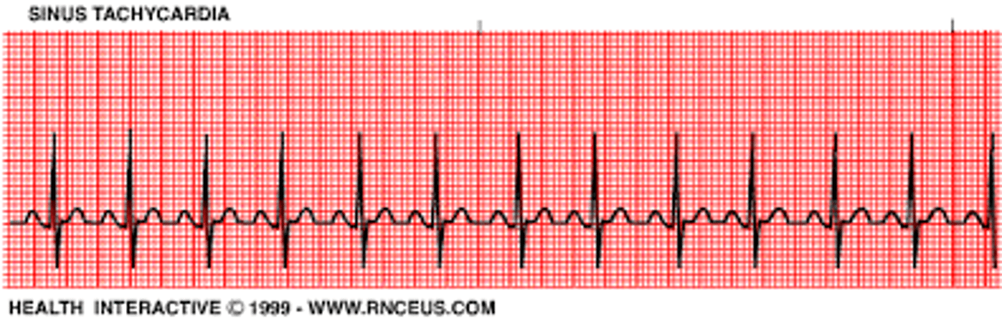 <p>Fast heart rate (greater than 100bpm).</p>